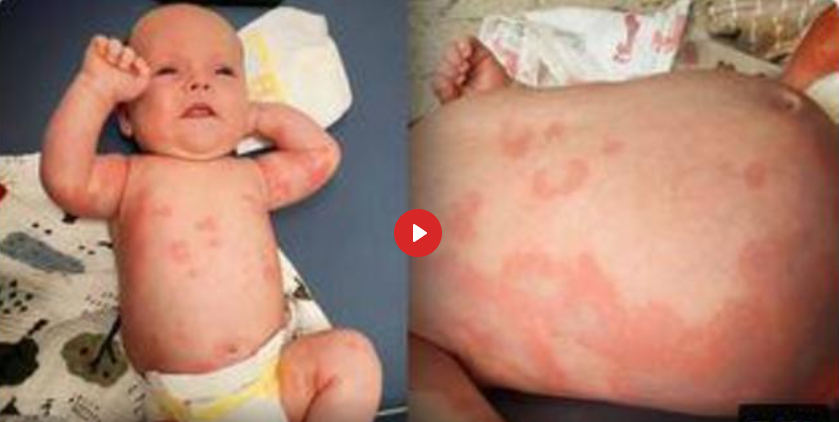 BABY HAS VACCINE REACTION FROM MOTHER’S BREAST MILK